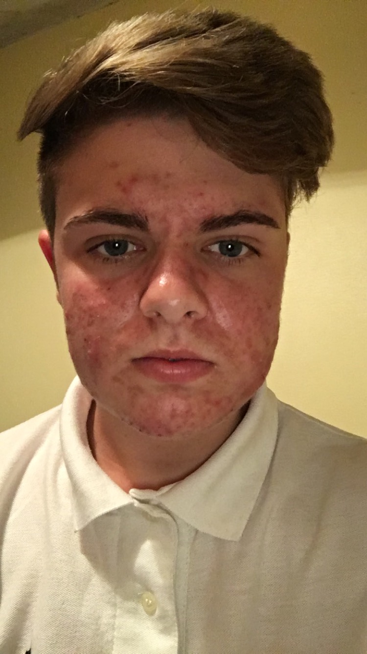 PICTURED - Josh before treatment with his ACNE.